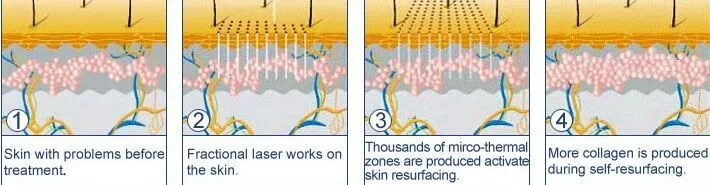 Minimally Invasive Acne Treatment RF Metal Laser Tube Fractional CO2 Scar Removal Laser